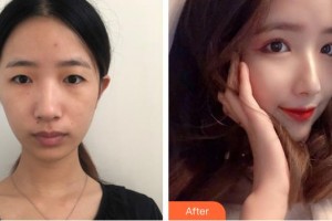 上海美爾雅醫(yī)療美容醫(yī)院張誠洙整形價格表附眼部綜合案例展示