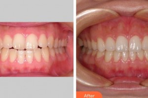 上海伊萊美醫(yī)療美容醫(yī)院李慶云整形價(jià)格表附隱形托槽矯正案例展示