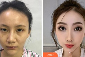 上海鉑曼醫(yī)療美容門診部楊群整形價(jià)格表附全切雙眼皮案例展示