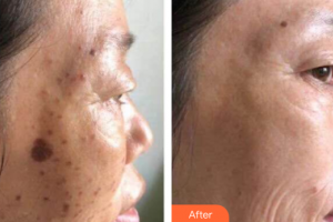 廣州美恩整形美容醫(yī)院鄧春燕整形價(jià)格表附激光美膚祛斑案例展示