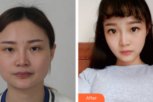 廣州中山醫(yī)博濟(jì)醫(yī)院整形美容中心黎葉整形價(jià)格表附DA·頜面整形案例展示