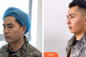 廣州解放軍第四五八醫(yī)院激光整形美容中心鐘衛(wèi)民整形價(jià)格表附祛痘印案例展示