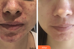 廣州新時(shí)代整形美容醫(yī)院熊英整形價(jià)格表附果酸煥膚案例展示