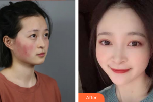 廣州遠(yuǎn)東美容醫(yī)院馮潔整形價(jià)格表附微針修復(fù)敏感肌案例展示