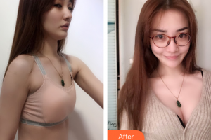 廣州星團(tuán)醫(yī)學(xué)美容門診部祖秉毅整形價(jià)格表附濃縮豐胸案例展示