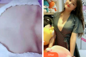 貴陽(yáng)長(zhǎng)江醫(yī)院整形美容中心韓盛斌整形價(jià)格表附假體隆胸案例展示