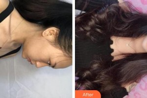 上海明慨醫(yī)療美容門診部陳建君整形價(jià)格表附果酸煥膚案例展示