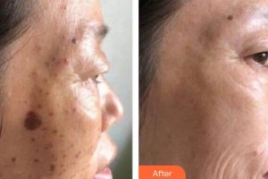 上海明慨醫(yī)療美容門診部田甜整形價(jià)格表附激光美膚激光祛斑案例展示