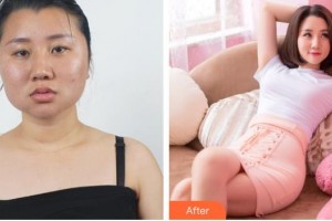 醫(yī)療美容門診部白承燦整形價(jià)格表附濃縮豐胸真實(shí)案例展示