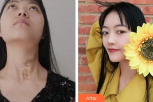 上海百達麗醫(yī)療美容醫(yī)院陳立彬整形價格表附燙傷疤痕修復案例展示