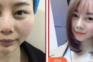 上海百達麗醫(yī)療美容醫(yī)院梁東民整形價格表附祛斑案例展示