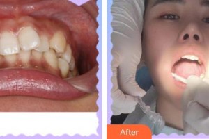 上海伊萊美醫(yī)療美容醫(yī)院李真旼整形價格表附牙綜合案例展示