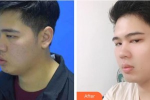 上海美立方整形醫(yī)院鄭裕賢整形價格表附面部輪廓案例展示