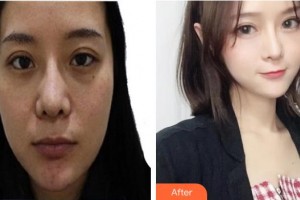 上海東方麗人美容醫(yī)療醫(yī)院曾廣華整形價格表附面部填充案例展示