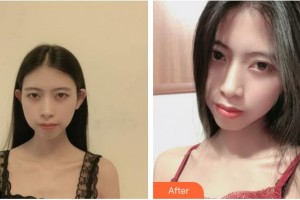 上海宸妃醫(yī)學美容醫(yī)院宋蔚整形價格表附微針美白嫩膚縮小毛孔案例展示