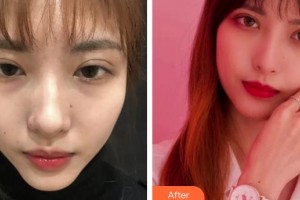 上海宸妃醫(yī)學美容醫(yī)院趙會平整形價格表附眼部綜合案例展示