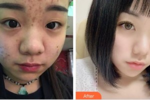 上海天大醫(yī)療美容醫(yī)院張杏整形價格表附點陣激光祛痘印痘坑案例展示