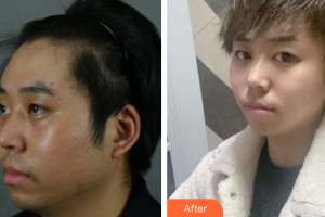 廣州星團(tuán)醫(yī)學(xué)美容門診部劉歡整形價(jià)格表附下頜角+皮質(zhì)骨+夾脂墊案例展示