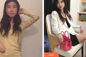 桂林華美醫(yī)療美容門診部趙麗紅整形價格表附玻尿酸導入精華案例展示