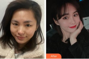 貴陽醫(yī)學院附屬醫(yī)院燒傷整形外科孔豫蘇整形價格表附眼部綜合案例展示