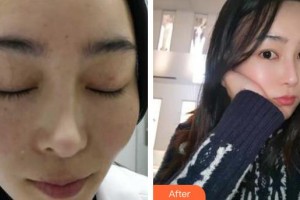 貴陽醫(yī)學院附屬醫(yī)院燒傷整形外科江濤整形價格表附祛斑案例展示