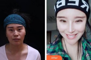 上海華美醫(yī)療美容醫(yī)院佀同帥整形價格表附埋線雙眼皮案例展示