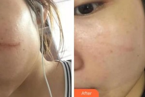 上海諾詩雅醫(yī)療美容醫(yī)院李東霓整形價格表附點陣激光案例展示