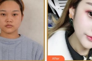 上海諾詩雅醫(yī)療美容醫(yī)院楊民鋒整形價格表附鼻部綜合案例展示