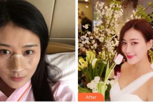 上海馥蘭朵醫(yī)療美容門診部劉小川整形價格表附鼻部手術案例展示