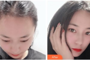 上海曙康口腔門(mén)診部康鈞棠整形價(jià)格表附發(fā)際線種植案例展示