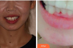 上海齊美口腔門(mén)診部方明浩整形價(jià)格表附超聲波潔牙案例展示