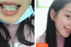 上海雅圣口腔門(mén)診部洪允義整形價(jià)格表附超聲波潔牙案例展示