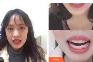 上海維佳康口腔醫(yī)院吳鳳霞整形價(jià)格表附隱形牙齒矯正案例展示