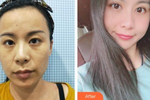 上海明潭眼科門(mén)診部王素羽整形價(jià)格表附眼部手術(shù)案例展示