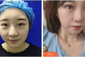 上海明潭眼科門(mén)診部趙竑彥整形價(jià)格表附眼部整形案例展示