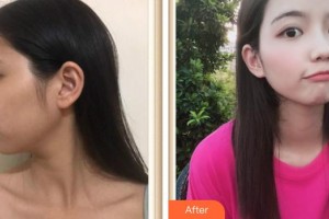 上海氧顏醫(yī)療美容門(mén)診部王建麗整形價(jià)格表附水氧案例展示