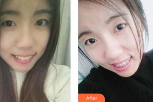 上海雅悅口腔門(mén)診部趙鄭整形價(jià)格表附金屬托槽矯正案例展示