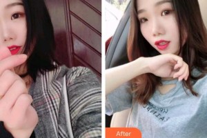 上海迪寇醫(yī)療美容門(mén)診部任亮整形價(jià)格表附多方面部埋線提升案例展示