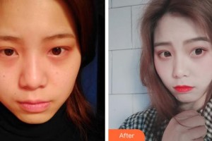 上海福仁眼科門(mén)診部王江橋整形價(jià)格表附全切雙眼皮案例展示