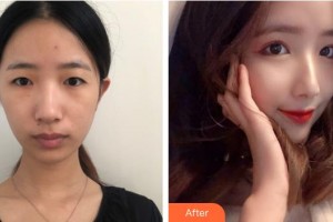 上海和平眼科醫(yī)院沈際穎整形價(jià)格表附眼部綜合案例展示