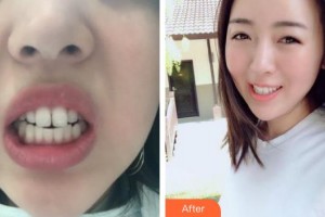 上海維樂口腔門診部沈華整形價格表附門牙擁擠、齙牙案例展示