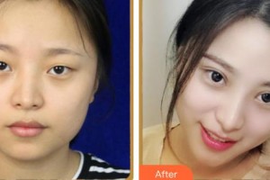 上海容妍醫(yī)療美容門診部柴云整形價格表附鼻部手術(shù)案例展示