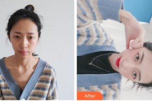 上海星璨醫(yī)療美容醫(yī)院劉宇整形價格表附發(fā)際線案例展示