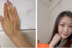 上海瑞金醫(yī)院舟山分院燒傷整形美容科郇京寧整形價格表附傷燙傷疤痕案例展示