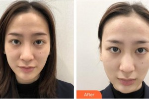 上海新形象整形外科門診部張桂蓉整形價(jià)格表附點(diǎn)陣激光案例展示