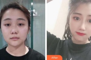 上海昕伊顏醫(yī)療美容醫(yī)院王君整形價(jià)格表附埋線雙眼皮案例展示