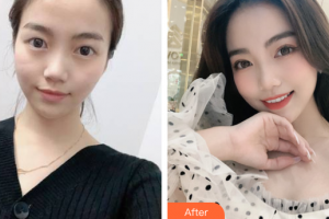 上海昕伊顏醫(yī)療美容醫(yī)院杜奕楠整形價(jià)格表附眼部綜合案例展示