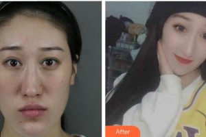 上海愛爾麗醫(yī)療美容門診部羅國銓整形價(jià)格表附多方面部吸脂瘦臉案例展示