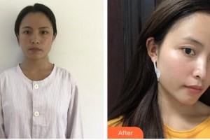 上海臻妮醫(yī)療美容門診部湯玉祥，男，主治醫(yī)生，畢業(yè)整形價格表附創(chuàng)可貼面部吸脂瘦臉案例展示