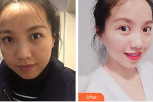 上海麗鉑醫(yī)療美容門診部淺井真太郎整形價格表附巨補水祛除暗沉淡化眼紋案例展示